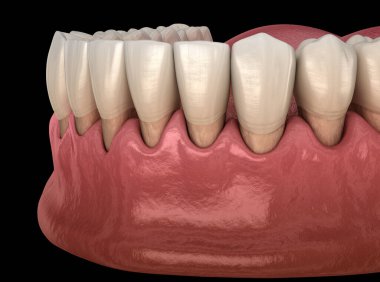 Gum recession process. Medically accurate 3D illustration clipart