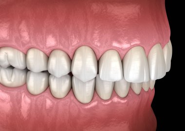Overbite diş tıkanıklığı ( Diş maloklüzyonu ). Tıbbi olarak doğru diş 3d illüstrasyon