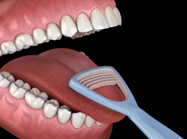 Dil temizliği - Kazıyıcı. Ağız hijyeni tıbbi olarak doğru 3d illüstrasyon.