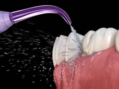 Tahriş edici, su dişleri temizliği. Ağız hijyeni tıbbi olarak doğru 3d illüstrasyon.