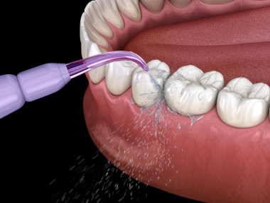 Tahriş edici, su dişleri temizliği. Ağız hijyeni tıbbi olarak doğru 3d illüstrasyon.
