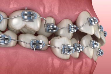 Anormal diş pozisyonu ve metal parantez tretament. Tıbbi olarak doğru diş 3d illüstrasyon