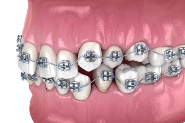 Anormal diş pozisyonu ve metal parantez tretament. Tıbbi olarak doğru diş 3d illüstrasyon