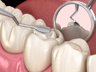 Bileşik dolgusu olan çürük diş restorasyonu. Tıbbi olarak doğru diş 3D illüstrasyon.