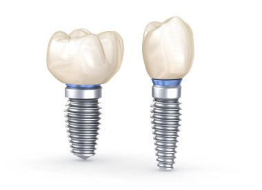Diş implantları. İnsan dişlerinin 3 boyutlu illüstrasyon kavramı