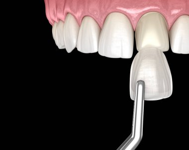 Merkezi kesici dişler üzerinde Dişçi Veneer kurulum işlemi. 3B illüstrasyon