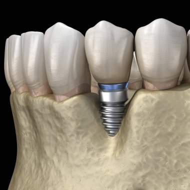 Görülebilir kemik küçültme ile perisiplantit. Diş implantı kavramının tıbben doğru üç boyutlu çizimi