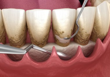 Açık curettage: Ölçekleme ve kök planlama (geleneksel periodontal terapi). İnsan diş tedavisinin tıbbi açıdan doğru üç boyutlu çizimi