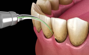 Lazer, enfeksiyon kapmış deri tabakasını ve diş temizliğini ortadan kaldırır. Tıbbi olarak doğru diş 3D illüstrasyon