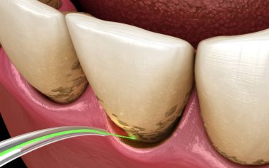 Lazer, enfeksiyon kapmış deri tabakasını ve diş temizliğini ortadan kaldırır. Tıbbi olarak doğru diş 3D illüstrasyon