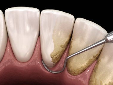 Kapalı kürettage: Ölçekleme ve kök planlama (geleneksel periodontal terapi). İnsan diş tedavisinin tıbbi açıdan doğru üç boyutlu çizimi