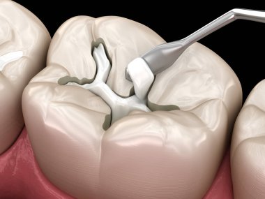 Diş dolgusu ile azı dişi yırtılması. Tıbbi olarak doğru diş 3D illüstrasyon.