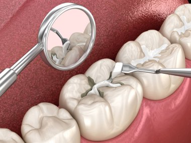 Diş dolgusu ile azı dişi yırtılması. Tıbbi olarak doğru diş 3D illüstrasyon.