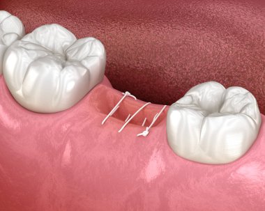 Stitches in gum after tooth extraction. 3D illustration of dental treatment