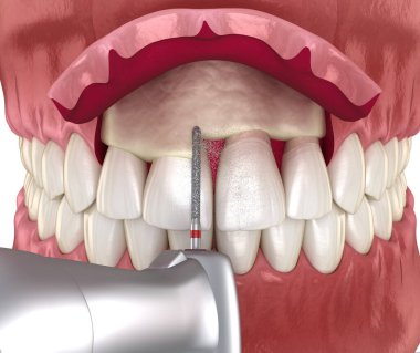 Frontal crown lengthening, Esthetic surgery. Medically accurate dental 3D illustration clipart