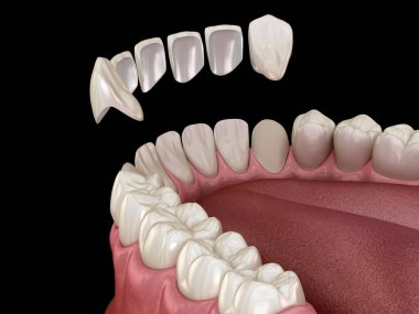 Merkezi kesici diş ve yan kesici dişler üzerinde vener kurulum prosedürü. Tıbbi olarak doğru diş 3D illüstrasyon