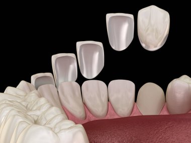 Merkezi kesici diş ve yan kesici dişler üzerinde vener kurulum prosedürü. Tıbbi olarak doğru diş 3D illüstrasyon