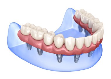 Çikletli Maxillary ve Mandibular protez. Hepsi de implantlarla desteklenen 8 sistemde. İnsan dişlerinin ve protezlerinin tıbbi açıdan doğru üç boyutlu çizimi