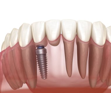 Cantilever Köprüsü implantı, ön diş tedavisi. Diş konseptinin tıbben doğru 3 boyutlu animasyonu