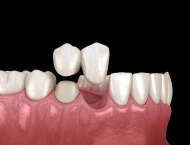 Cantilever Köprüsü, seramik ve ön dişlerden yapılmış. Diş konseptinin tıbben doğru 3 boyutlu animasyonu