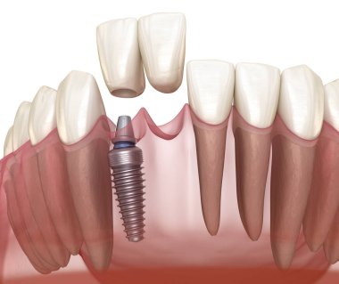 Cantilever Köprüsü implantı, ön diş tedavisi. Diş konseptinin tıbben doğru 3 boyutlu animasyonu