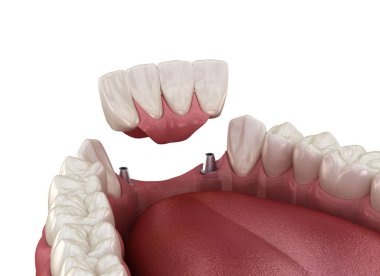 Ön diş köprüsü implantlarla destekleniyor. Diş konseptinin tıbben doğru 3D animasyonu