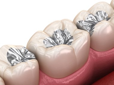 Amalgam restoration. Medically accurate 3D animation of dental concept clipart