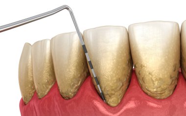 Periodontitis testing, gum recession process. Medically accurate 3D illustration clipart