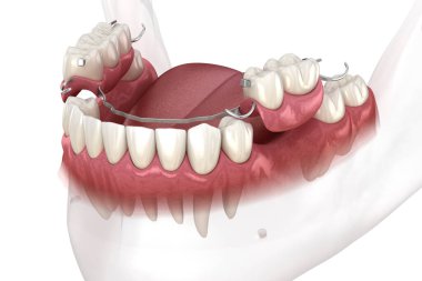 Çıkarılabilir kısmi takma diş, çene protezi. Medikal olarak protodontik konseptin 3 boyutlu çizimi