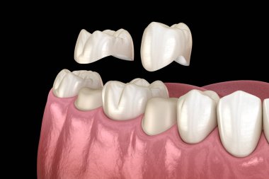 Porcelain crowns placement over premolar and molar teeth. Medically accurate 3D illustration