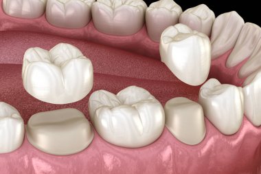 Porcelain crowns placement over premolar and molar teeth. Medically accurate 3D illustration