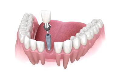 İmplantla azı dişi alınıyor. İnsan dişleri ve protez kavramının tıbben doğru üç boyutlu çizimi