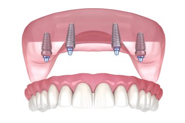 Çikletli Maxillary protezi. Hepsi de implantlarla desteklenen 4 sistemde. İnsan dişlerinin ve protezlerinin tıbbi açıdan doğru üç boyutlu çizimi