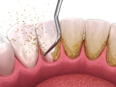 Ağız temizliği: Ölçekleme ve kök planlama (geleneksel periodontal terapi). İnsan diş tedavisinin tıbbi açıdan doğru üç boyutlu çizimi