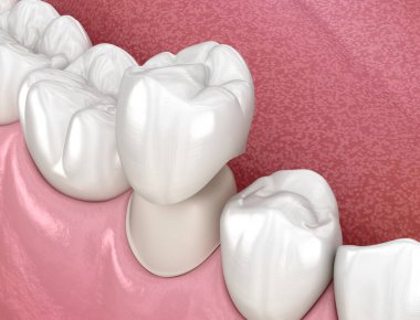 Hazırlanmış azı dişi ve diş kaplaması. Tıbbi olarak doğru 3B illüstrasyon