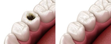 Premolar tooth restoration with filling after caries damage. Medically accurate tooth 3D illustration.