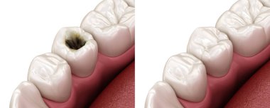 Premolar tooth restoration with filling after caries damage. Medically accurate tooth 3D illustration. clipart