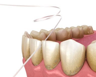 Diş ipi temizleme işlemi. Tıbbi olarak doğru olan 3 boyutlu diş illüstrasyonu