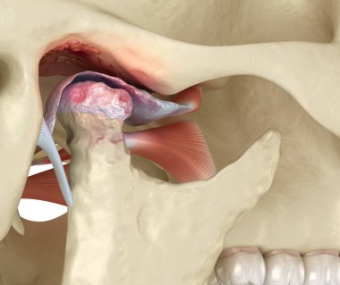 Temporomandibular eklem iltihabı ve yerinden çıkmış eklem diski. Tıbbi olarak doğru 3B illüstrasyon.