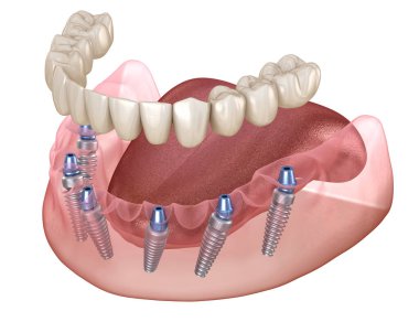 Çikletli çene protezi. Hepsi de implantlarla desteklenen 6 sistemde. İnsan dişleri ve protez kavramının tıbben doğru üç boyutlu çizimi