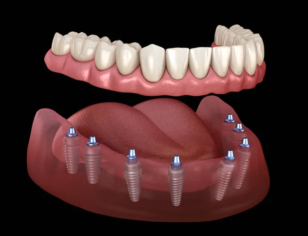 Мандибулярний Протез Системах Підтримується Імплантатами Медично Точна Ілюстрація Концепції Зубів — стокове фото