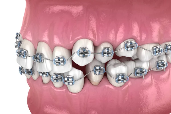 Ανώμαλη Θέση Των Δοντιών Και Μεταλλικά Άγκιστρα Tretament Ιατρικά Ακριβής — Φωτογραφία Αρχείου