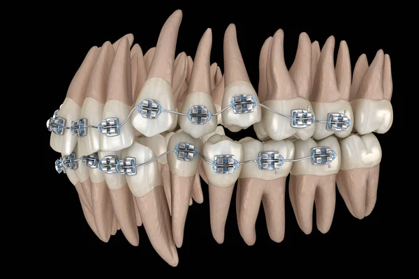 Dentes Anormais Posição Metal Aparelho Tretamento Ilustração Odontológica Medicamente Precisa — Fotografia de Stock