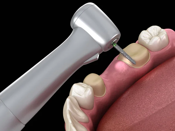 Prämolare Präparation Für Die Platzierung Der Zahnkrone Medizinisch Korrekte Illustration — Stockfoto