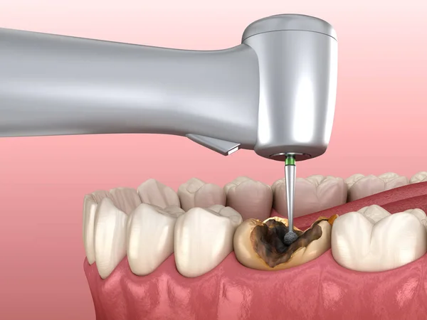 Caries removing process. Medically accurate tooth 3D illustration.