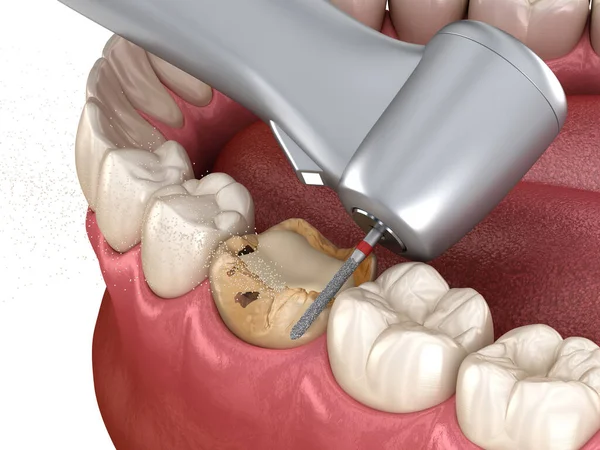 Caries Removing Process Medically Accurate Tooth Illustration — Stock Photo, Image