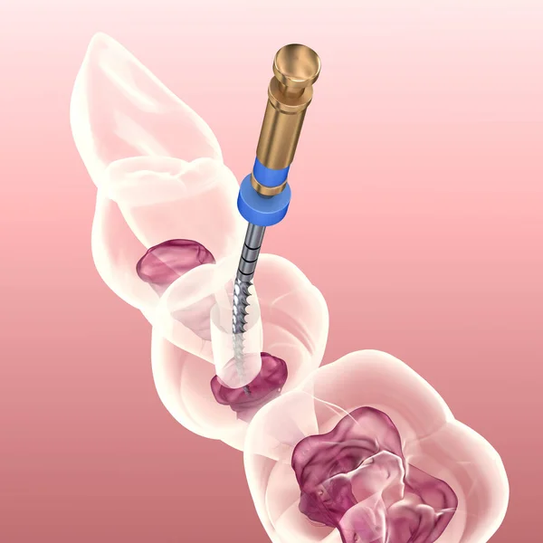 Endodontisk Rotfyllningsbehandling Medicinskt Korrekt Tand Illustration — Stockfoto
