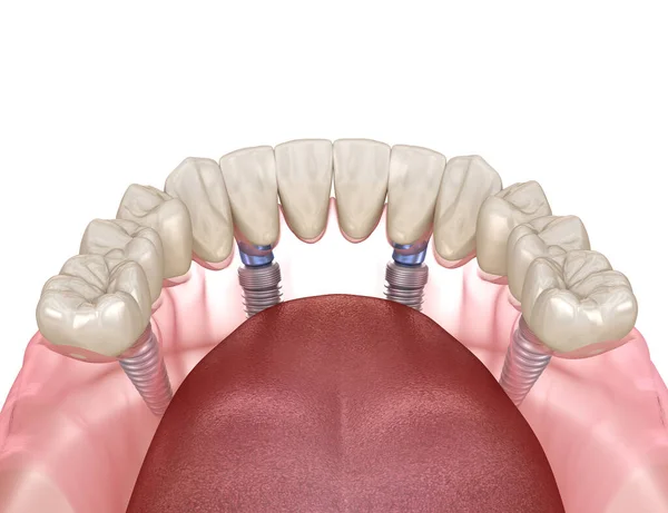 Mandibulární Protéza Vše Systému Podporované Implantáty Lékařsky Přesná Ilustrace Konceptu — Stock fotografie