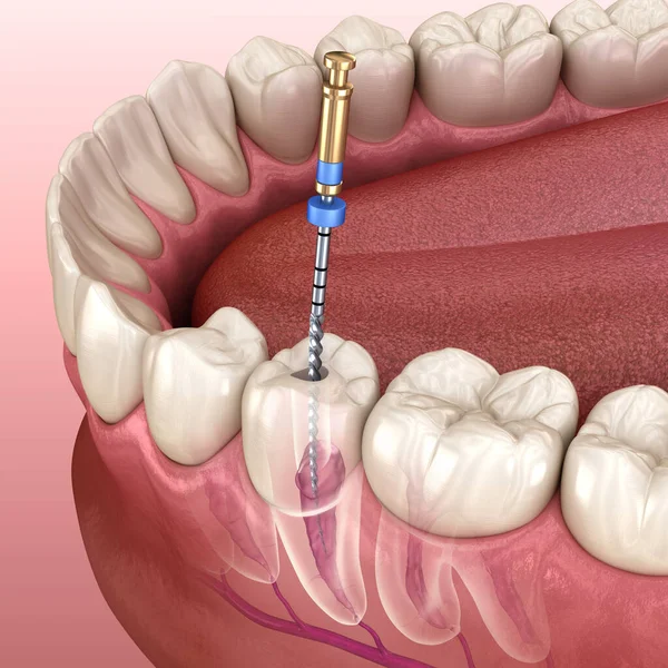 Endodontic Root Canal Treatment Process Medically Accurate Tooth Illustration — Stock Photo, Image