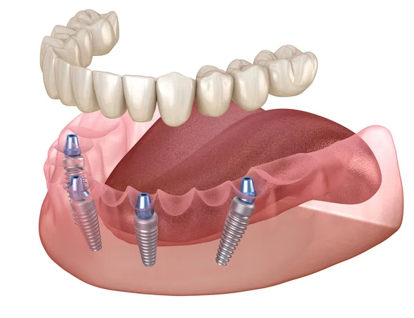 Prothèse Mandibulaire Tout Sur Système Soutenu Par Des Implants Illustration — Photo